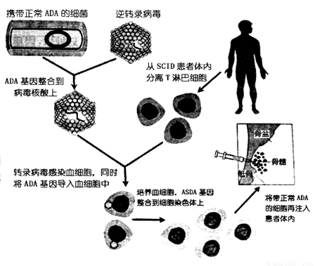 重症联合性免疫缺陷病是一种体液免疫、细胞免